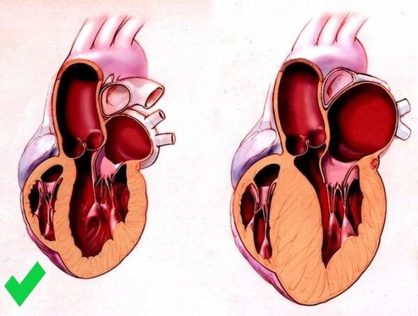 Cardione verhindert eine ventrikuläre Hypertrophie des Herzens